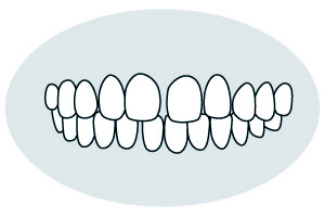 空隙歯列（くうげきしれつ）・すきっ歯